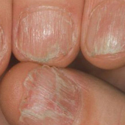 malattia delle unghie
