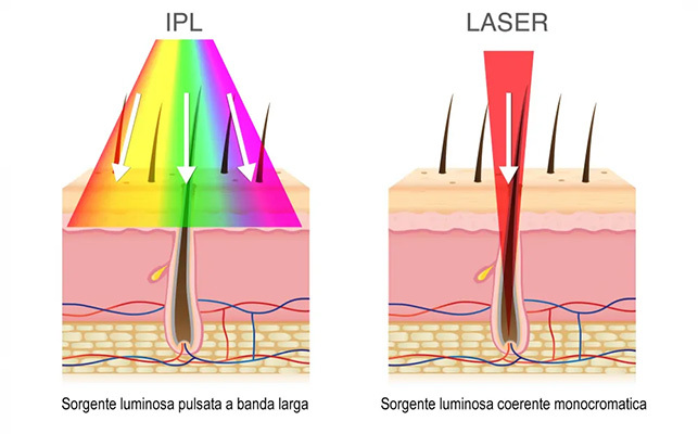 differenza luce pulsata laser